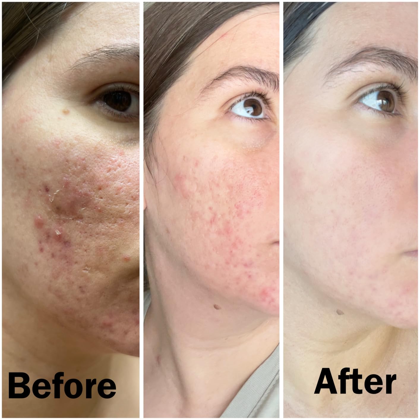 AcneFree Terminator 10 Acne Spot Treatment with Benzoyl Peroxide 10% Maximum Strength Acne Cream Treatment, 1 Ounce - Pack Of 1 customer photo 2