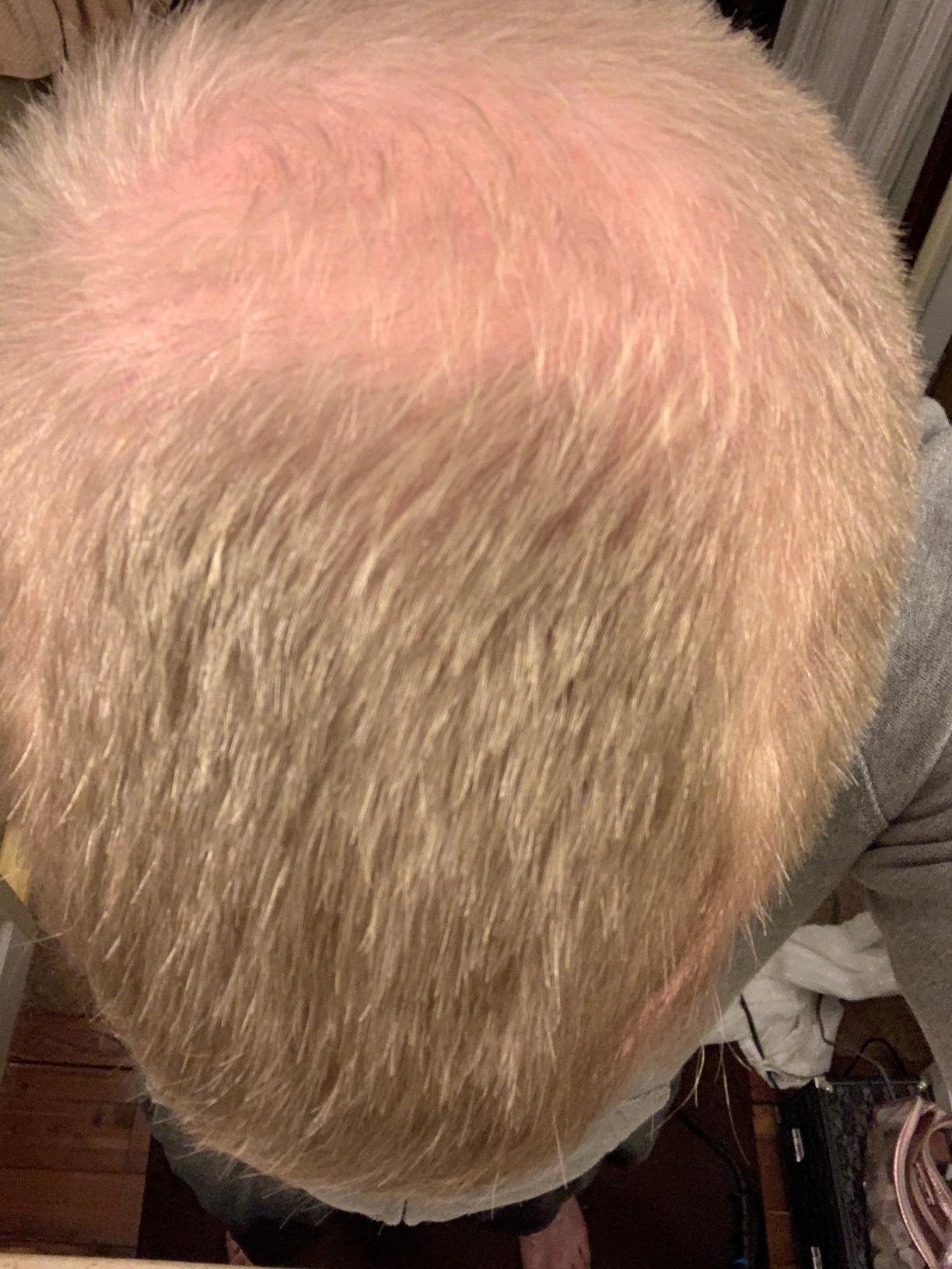 iRestore Essential - Laser Red Light Therapy for Hair Growth - FDA Cleared Hair Loss, Hair Thinning & Alopecia Treatment for Men & Women - Laser Cap for Hair Regrowth Stimulate Denser Fuller Hair customer photo 1