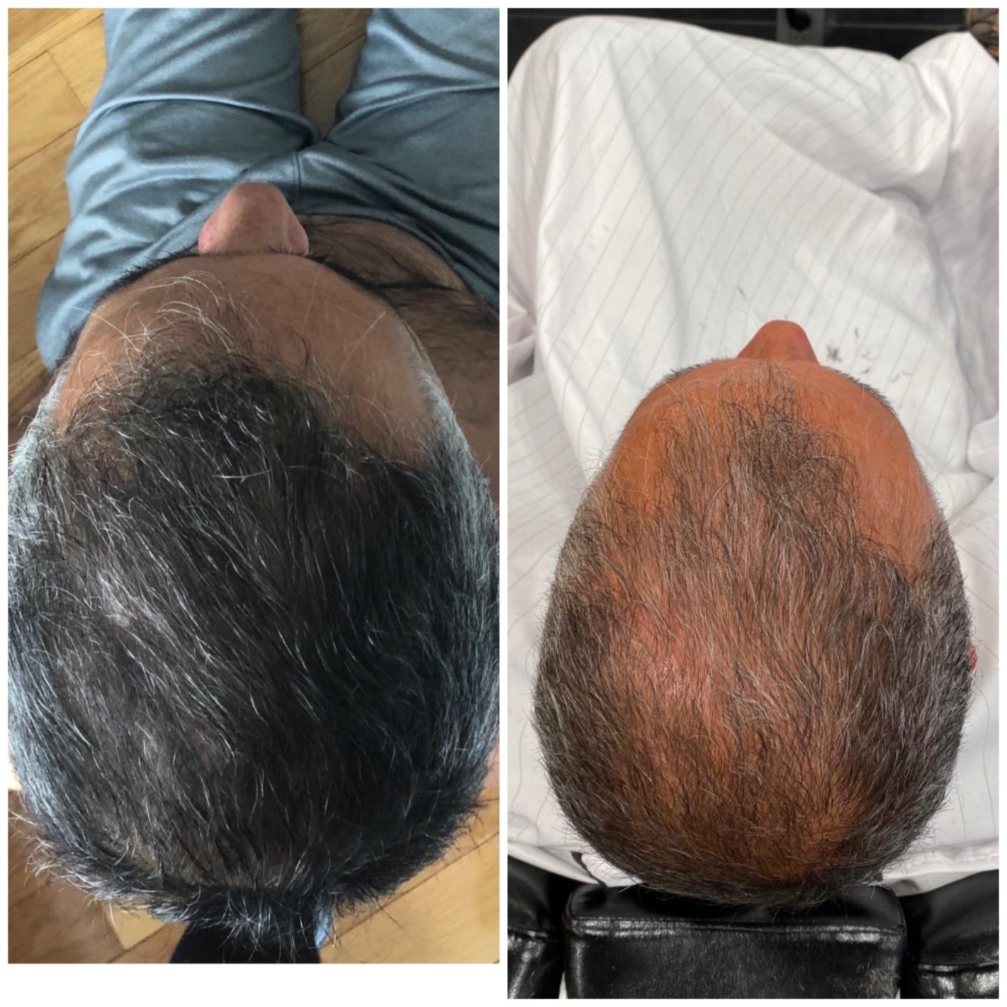 Hairmax RegrowMD FDA Cleared Laser Hair Growth Cap, Medical Grade Lasers, Red Light Therapy for Hair Growth & Alopecia Areata Treatment, 30 Min Sessions, For Men & Women customer photo 1