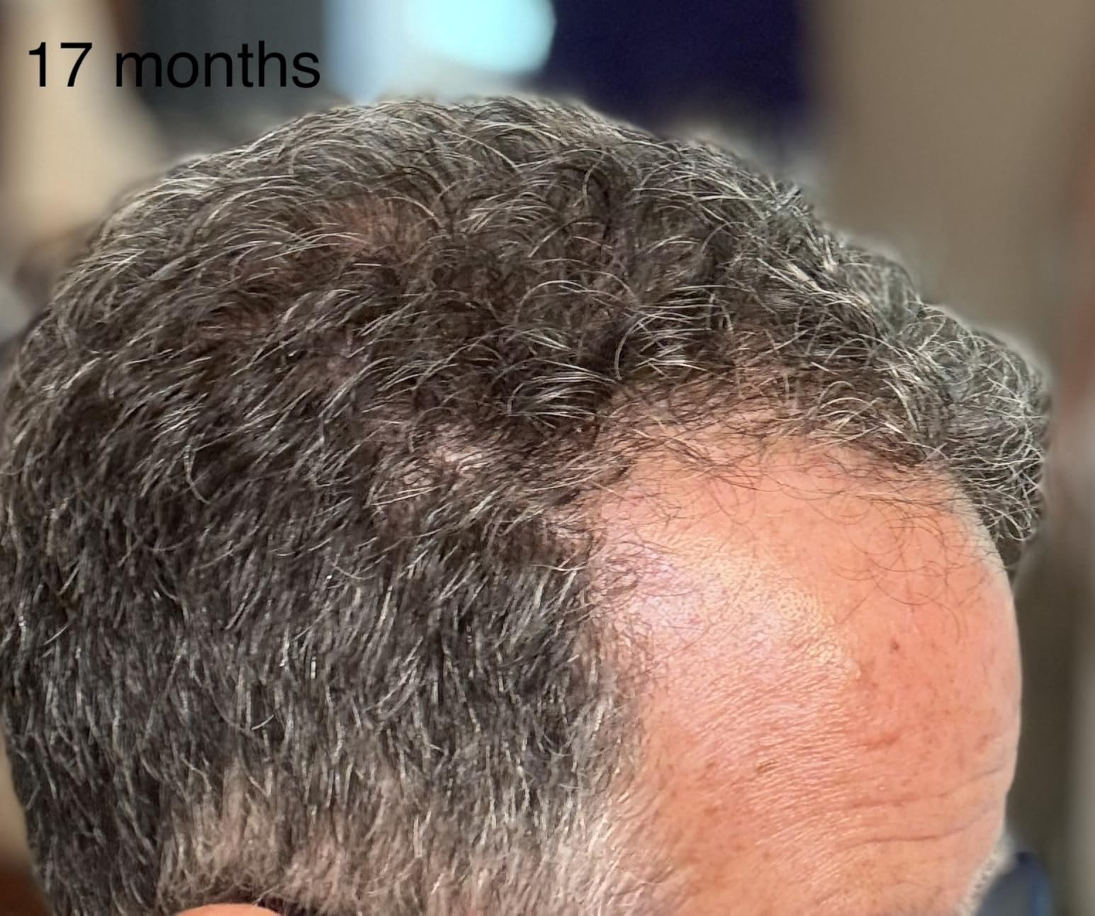 iRestore Professional Laser Red Light Therapy for Hair Growth System - FDA Cleared Hair Loss, Hair Thinning & Alopecia Treatment for Men & Women - 282 Lasers & LEDs customer photo 1