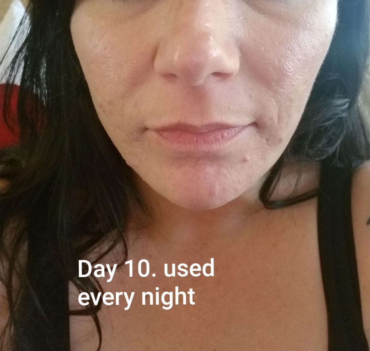 The Ordinary Lactic Acid 10% + Hyaluronic Acid 2%, High-Strength Exfoliating Serum for Smoother, Brighter Skin, 1 Fl Oz customer photo 1