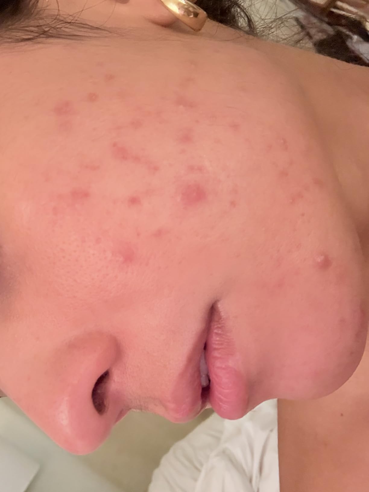 La Roche-Posay Effaclar Adapalene Gel 0.1% Acne Treatment, 1.6oz | Retinoid cream acne medication gel for blackheads and whiteheads. Oil free formula helps clear blemishes and clogged pores. customer photo 2