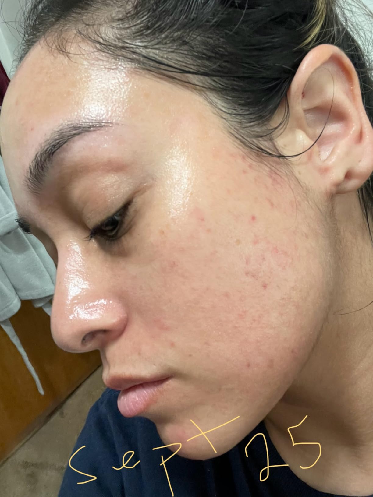 Acne Free Adapalene Gel 0.1%, Once-Daily Topical Retinoid Acne Treatment, Dermatologist Developed, Unclogs Pores and Clears Acne, Prevents and Improve Whiteheads and Blackheads, 0.5 Ounce customer photo 2