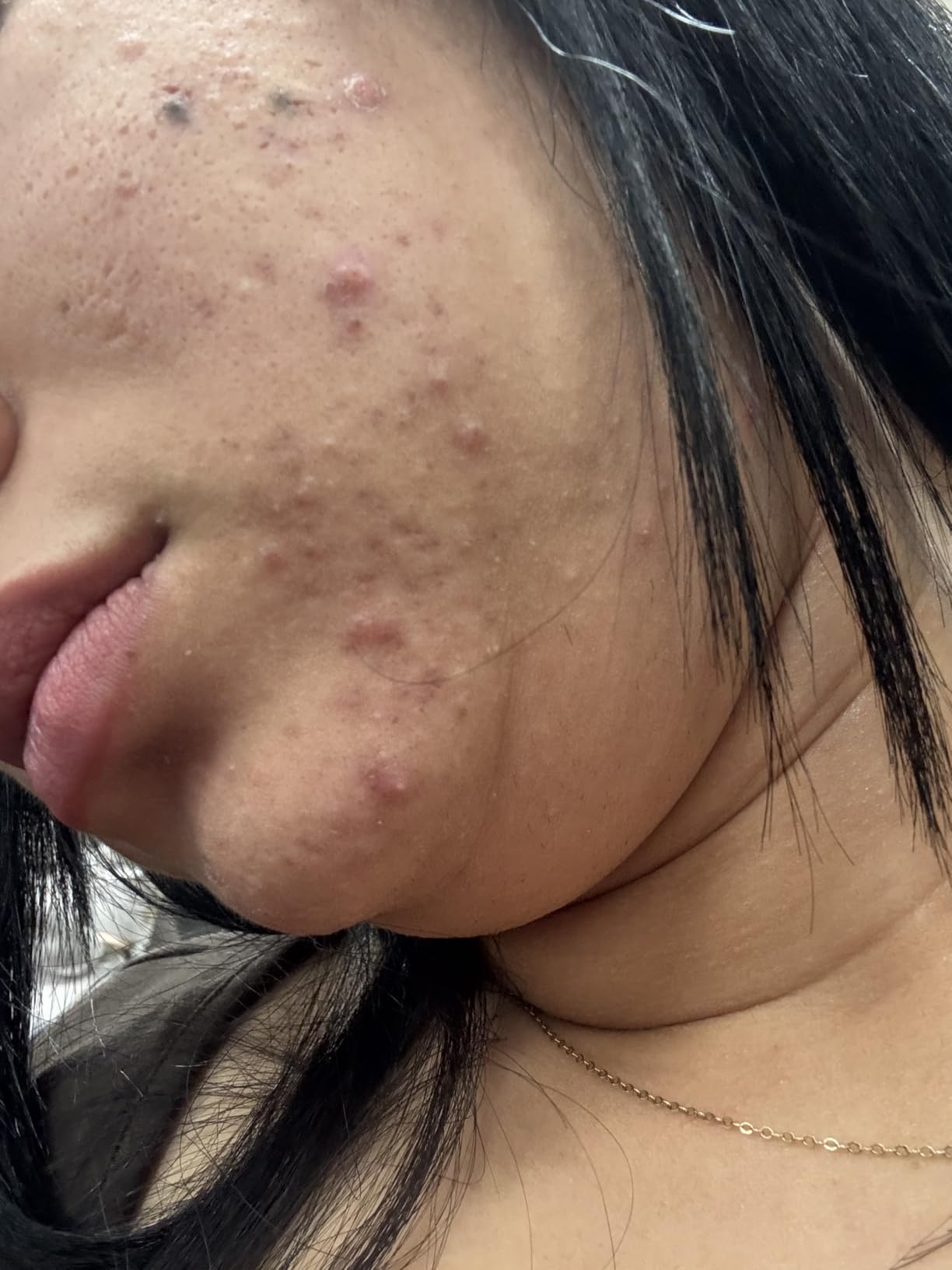 CeraVe Acne Control Cleanser, Face Wash with 2% Salicylic Acid, 16 oz customer photo 1