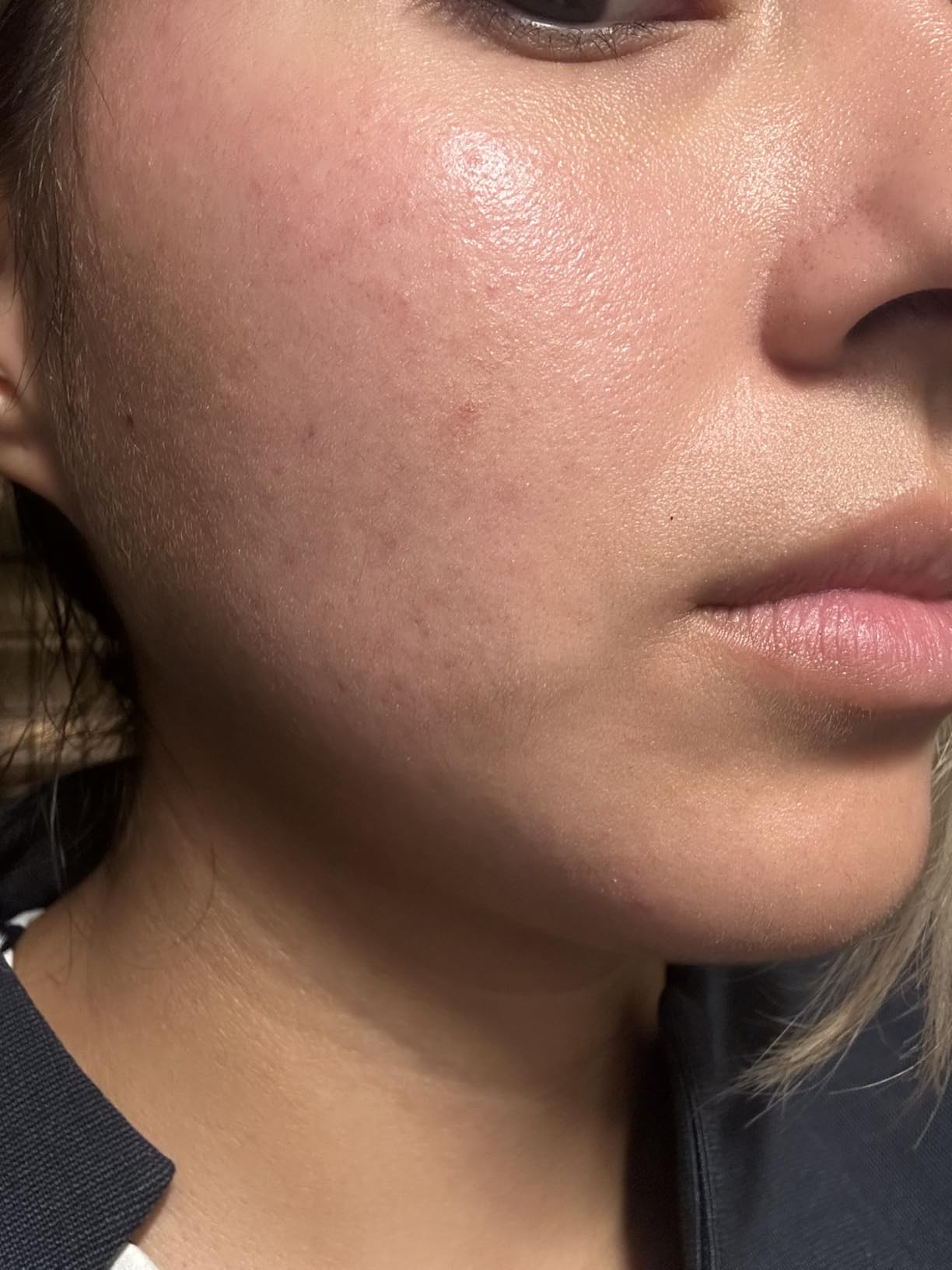 Neutrogena Adapalene Gel 0.1% Acne Treatment, 1.6 oz | Topical for Acne, Adapalene Medication for Blemishes, Once Daily Topical Retinoid, Oil & Fragrance-Free customer photo 2