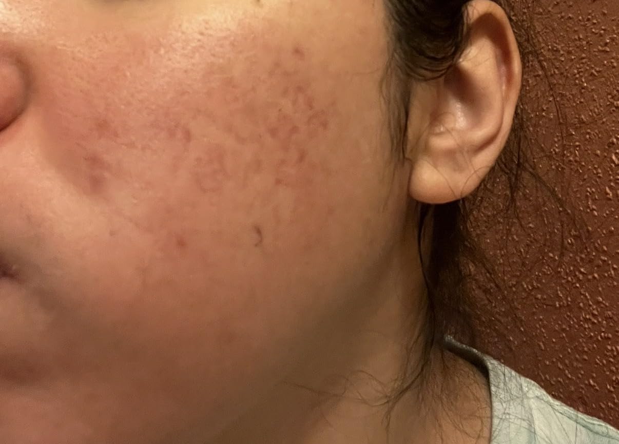 Paula's Choice 6% Mandelic + 2% Lactic Acid Liquid Exfoliant | Gentle AHA Exfoliation for Discoloration, Bumpy Texture & Radiance, for Sensitive Skin, Fragrance-Free customer photo 2