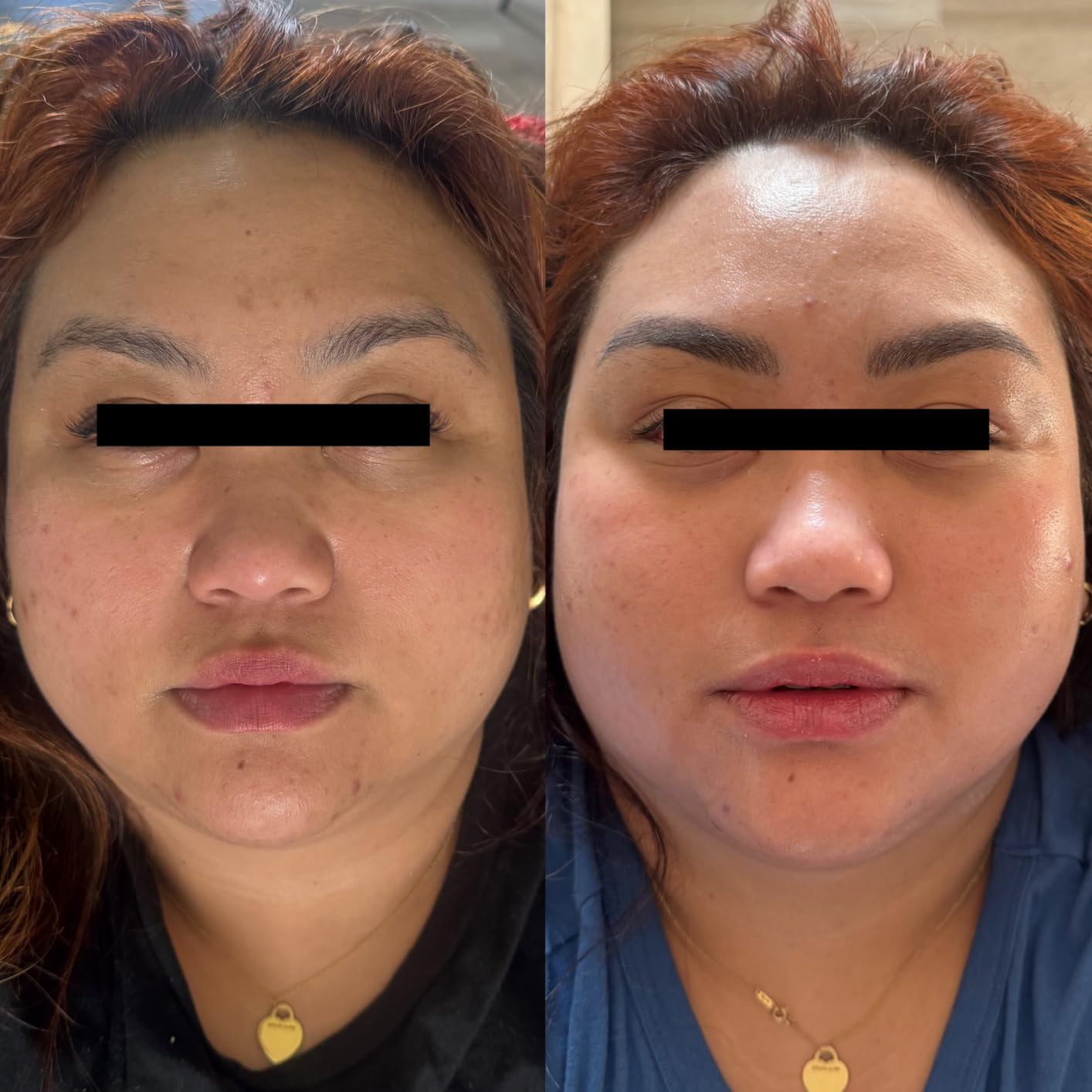 Anua Azelaic Acid 10 Hyaluron Redness Soothing Serum, 1.01 fl oz | Facial Serum for Blemish-Prone & Oily-Prone Skin, Lightweight & Hydrating Blemish Care, Hyaluronic Acid, Korean Skincare customer photo 2