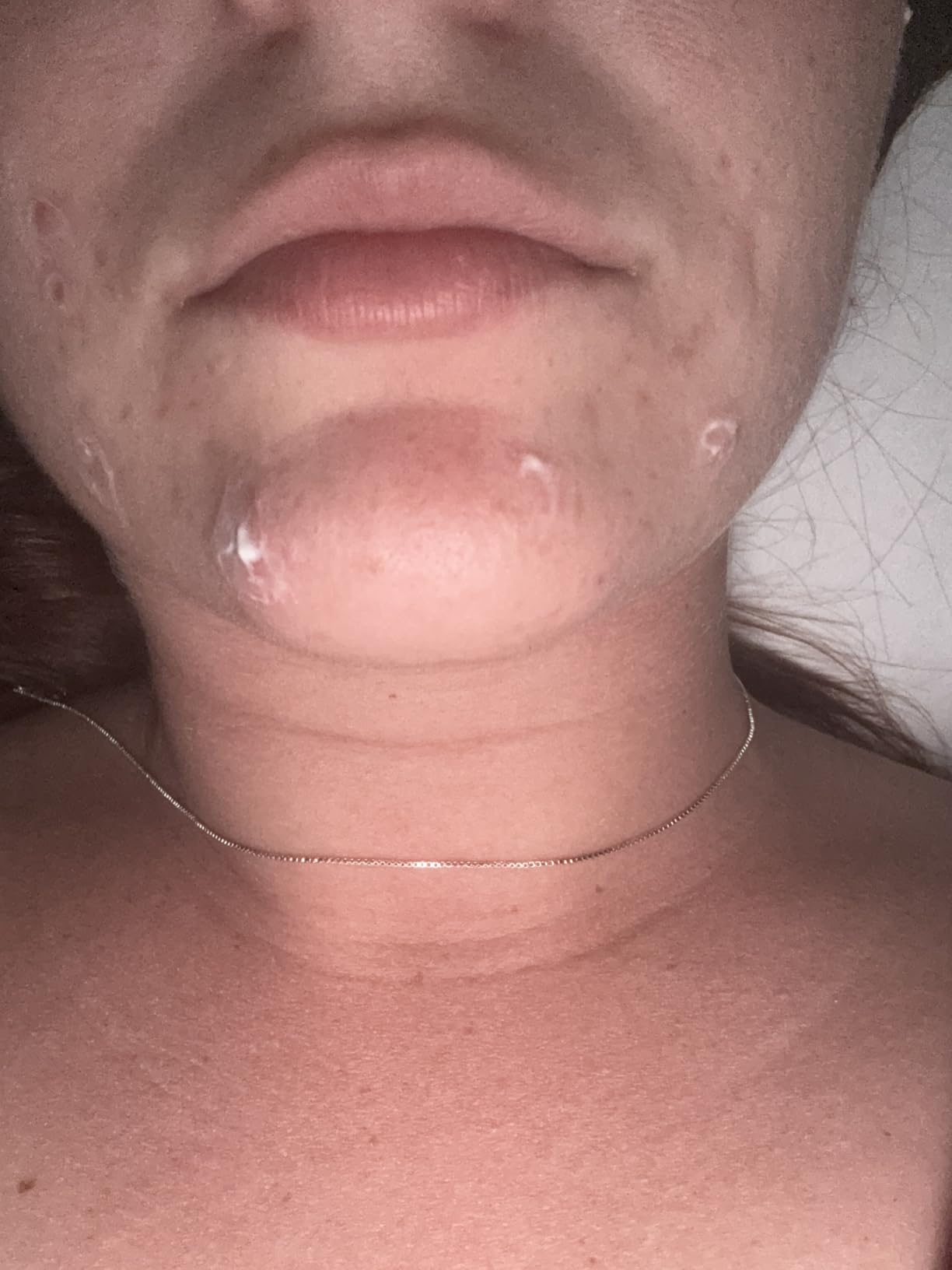 La Roche-Posay Effaclar BPO Multi-Target Acne Treatment, Benzoyl Peroxide | Acne cream with 5.5% Micronized Benzoyl Peroxide. Targets oily skin, blackheads, & pimples. Dermatologist recommended. customer photo 1
