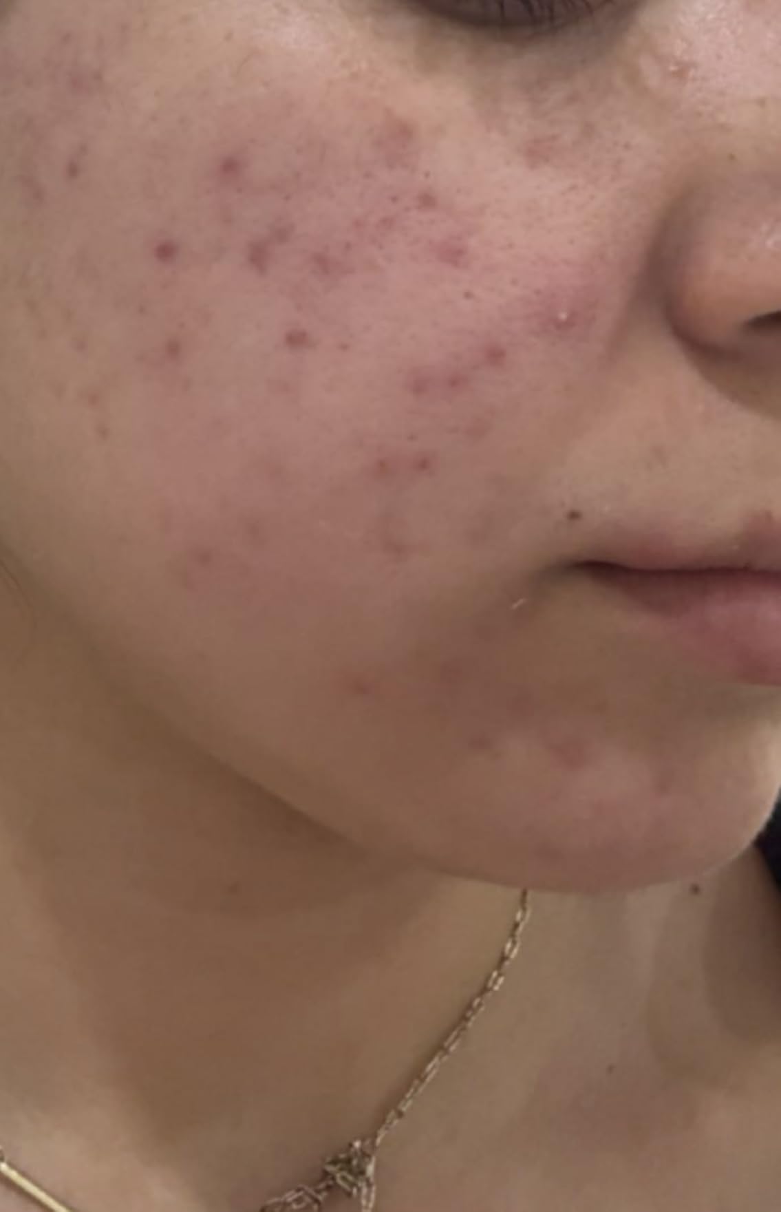 Good Molecules 10% Azelaic Acid Treatment for Face - Blurs Facial Redness & Evens Skin Tone - Brightens the Look of Dark Spots & Refines Texture - Vegan & Fragrance-Free Skincare (30ml / 1.01 fl oz.) customer photo 1